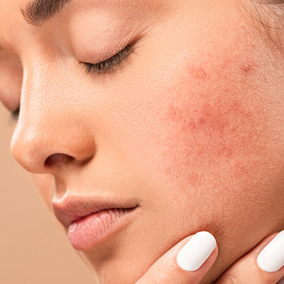 Blemish & Acne-Prone Skin